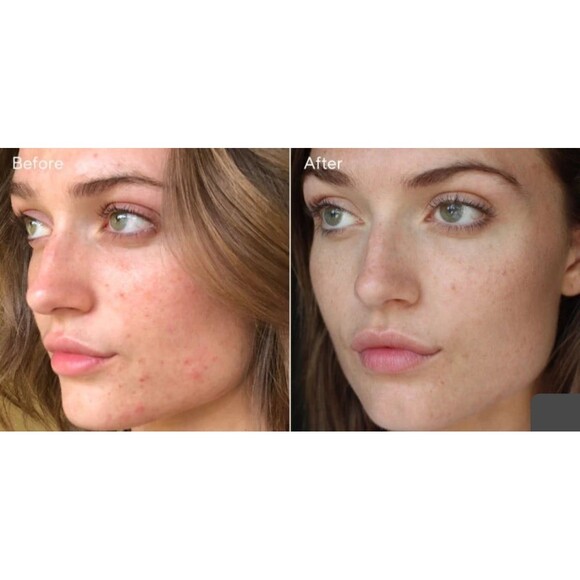Murad InvisiScar Resurfacing Treatment FULL SIZE - Picture 9 of 12